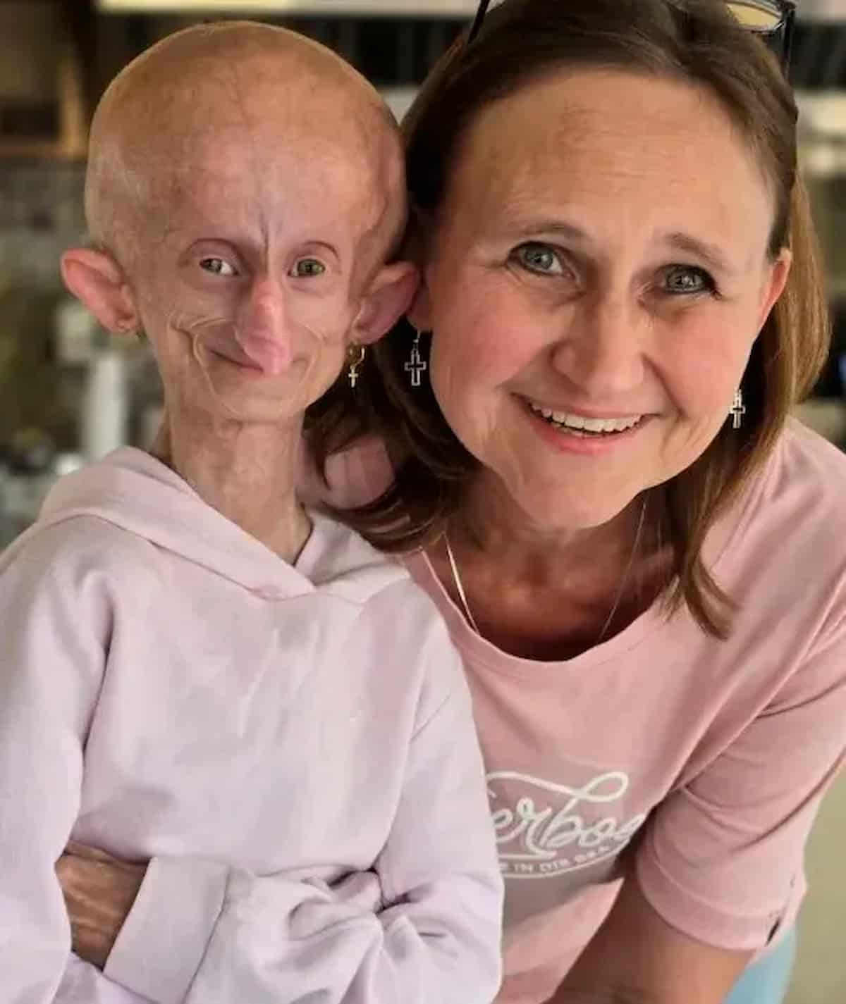 Beandri Booysen con la madre: è morta prima di Natale: era già vissuta 19 anni, ben oltre i 14 anni di vita dei malati di progeria 