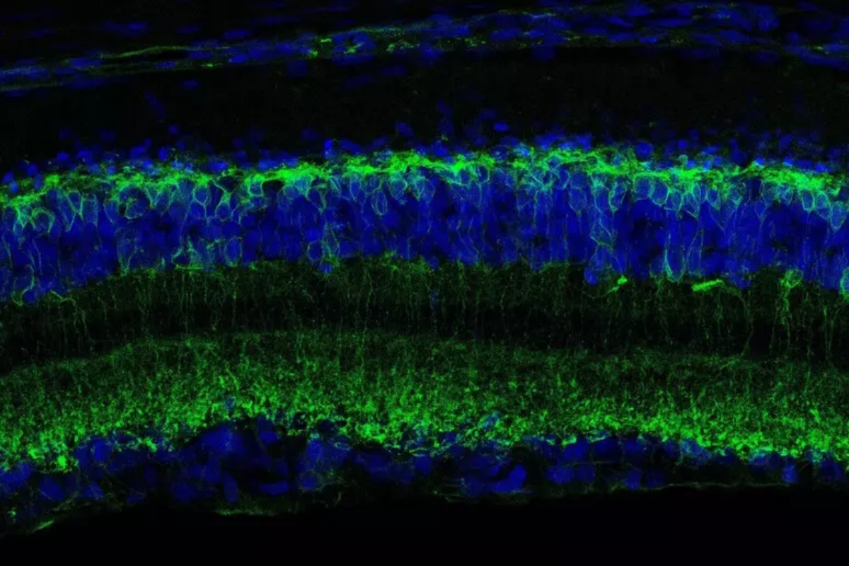 sezione trasversale di retina danneggiata