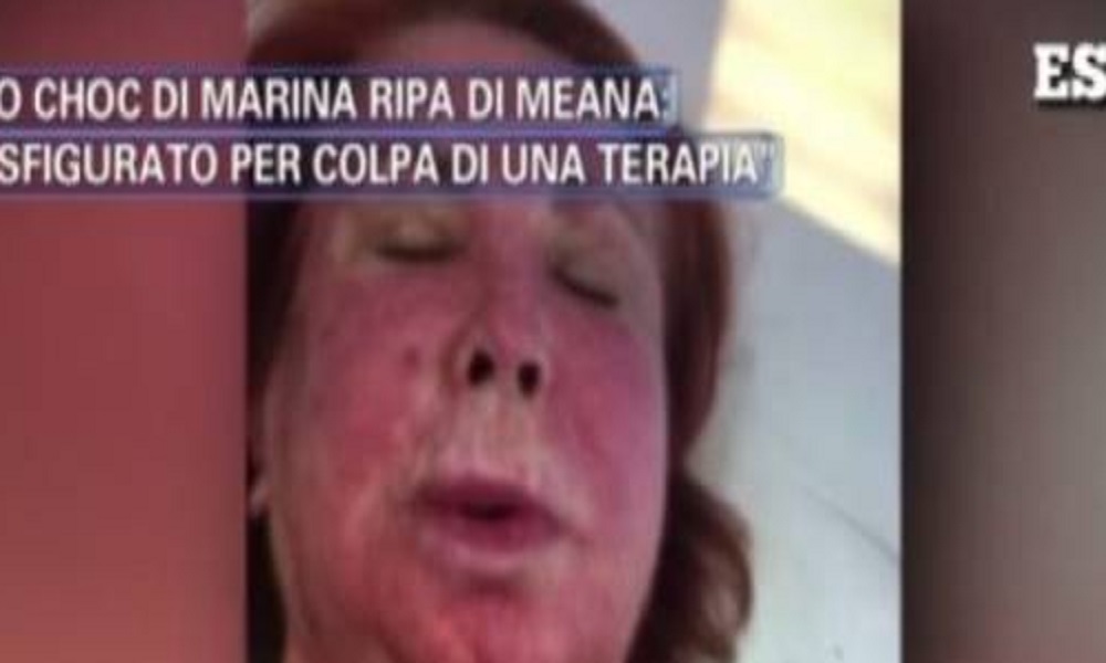 Pomeriggio 5, Marina Ripa di Meana sfigurata: "Ho il volto sfregiato a causa di una terapia anti-cancro"