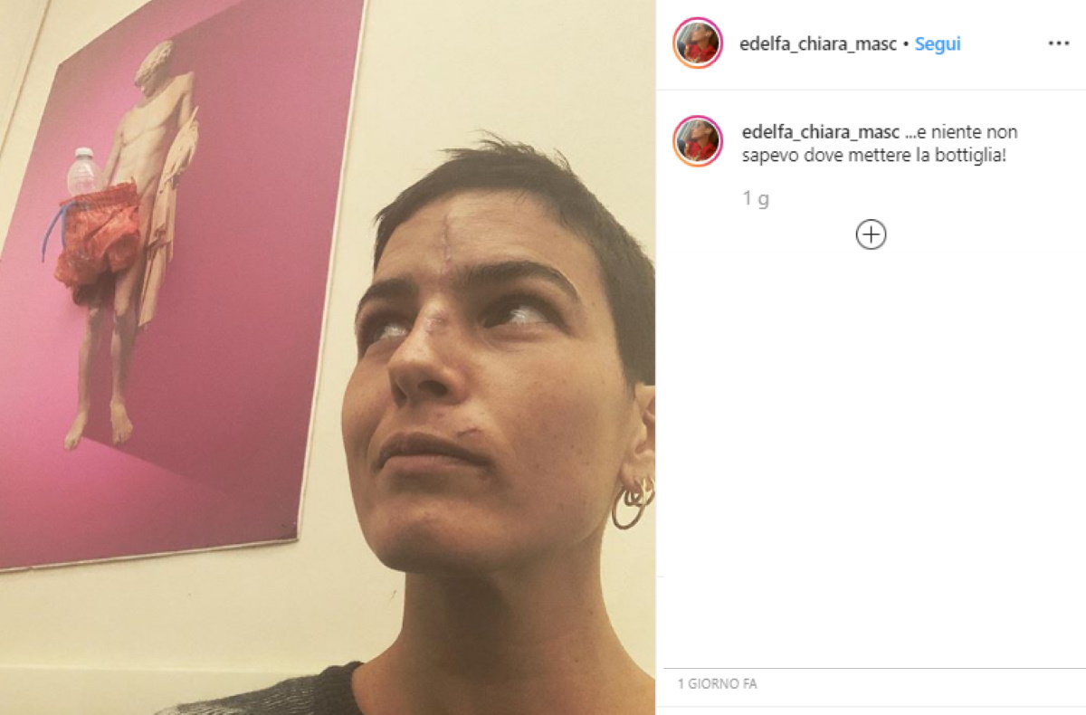 Edelfa Chiara Masciotta e la foto delle cicatrici su Instagram dopo l'incidente