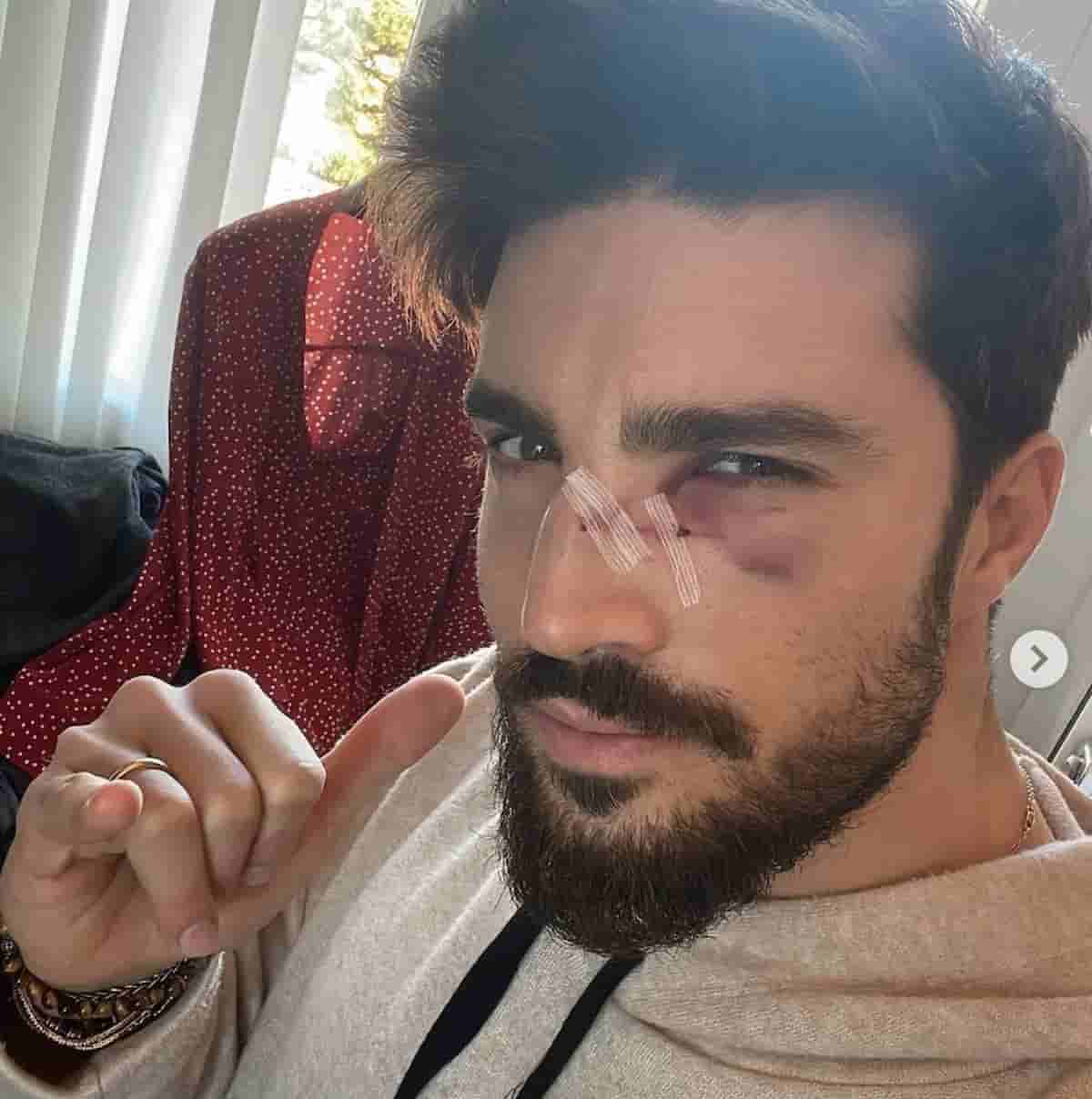 Mariano Di Vaio, incidente a padel: una racchetta sul naso. Il video social: "Quattro ore in ospedale"