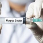 Herpes Zoster