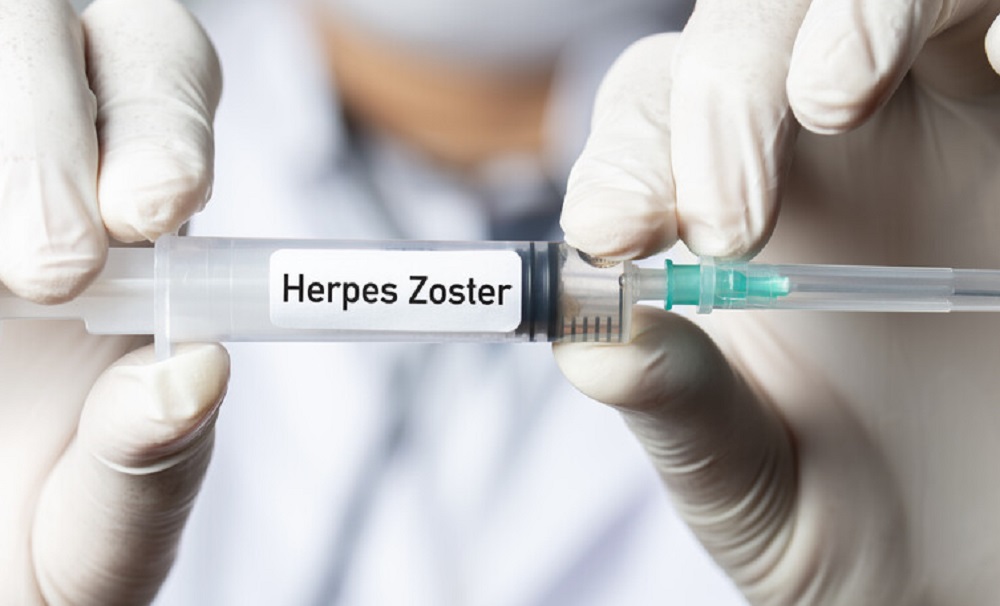 Herpes Zoster