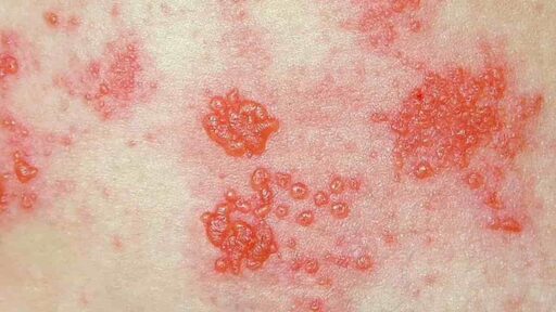 La pelle manda segnali, non trascurateli: dal fuoco di S.Antonio alla meningite, ecco 9 malattie