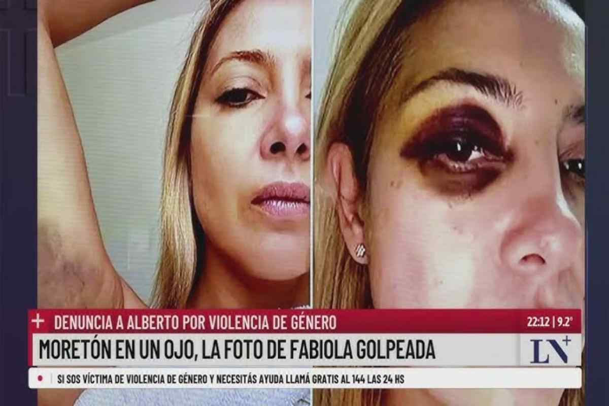 Fabiola Yáñez, l'ex first lady argentina picchiata dal marito Alberto Fernandez: le foto col volto tumefatto