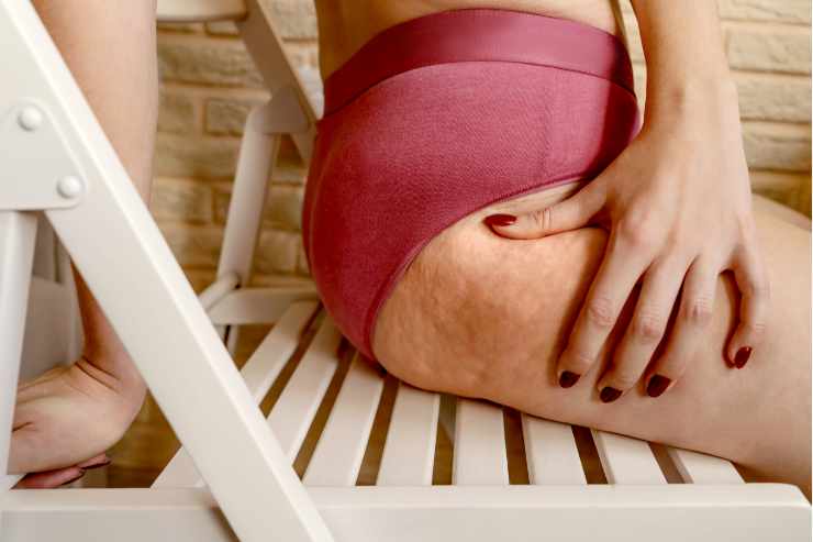 donna con cellulite seduta su una sedia