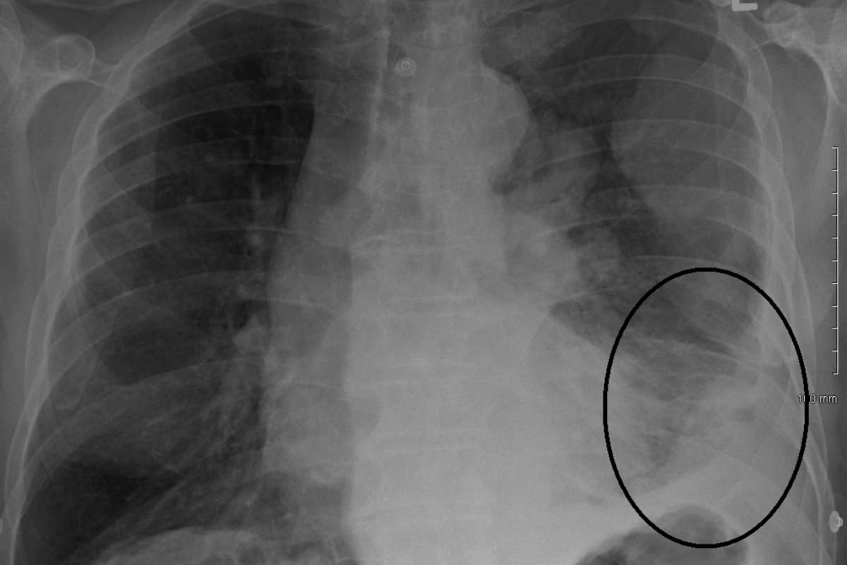 mesothelioma cxr