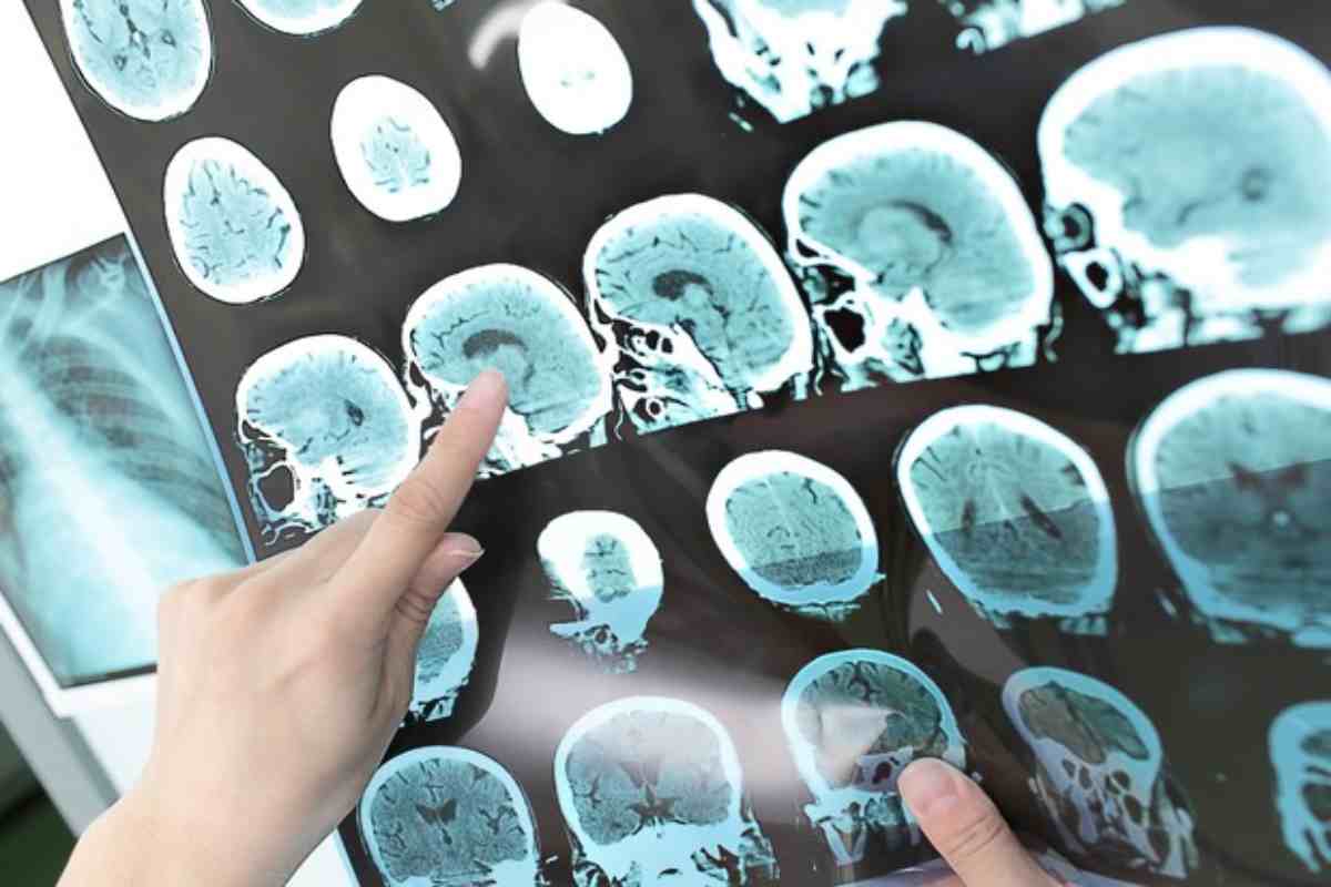 La radiografia di un cervello