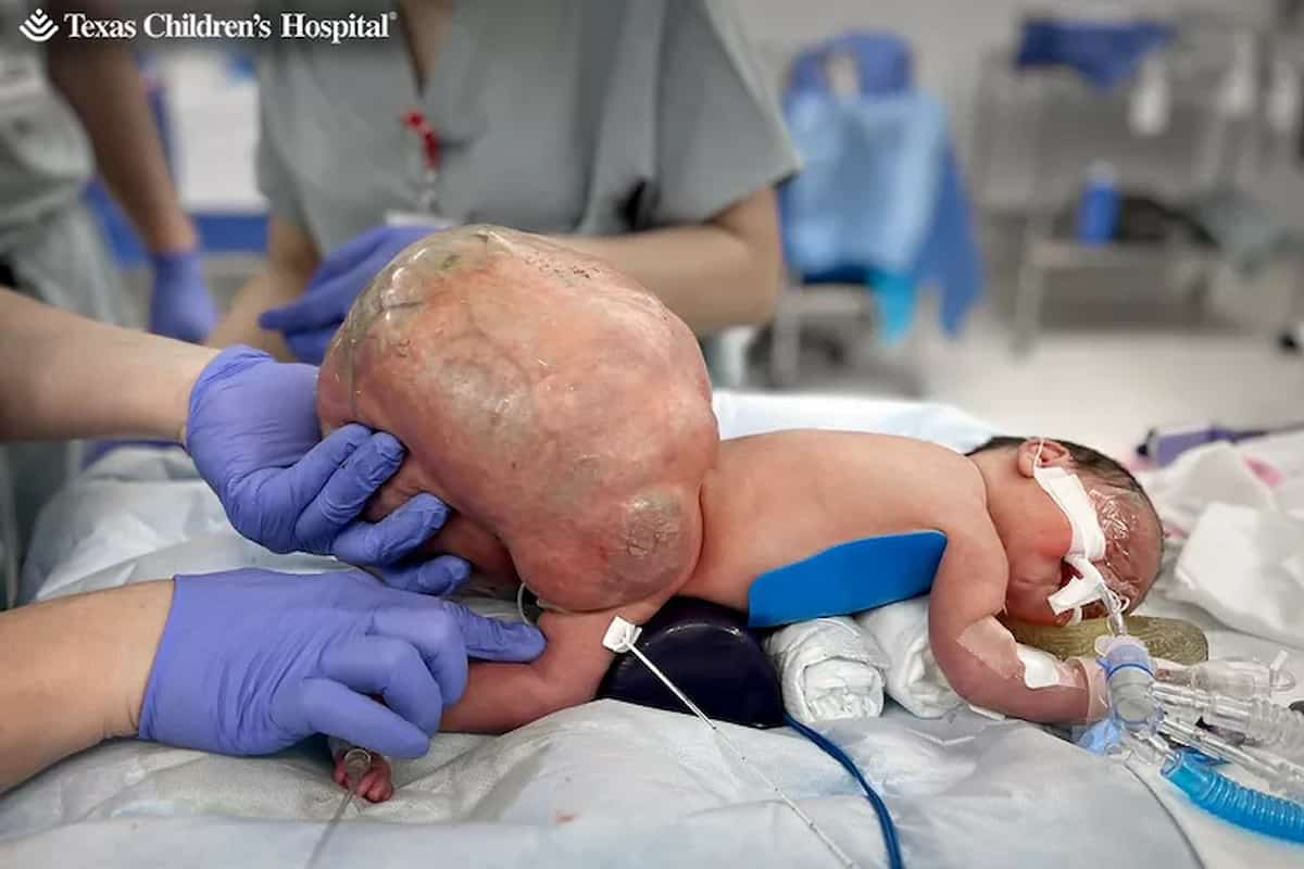 Il tumore è quasi più grosso della bambina