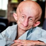 Beandri Booysen morta prima di Natale: era già vissuta 19 anni, ben oltre i 14 anni di vita dei malati di progeria