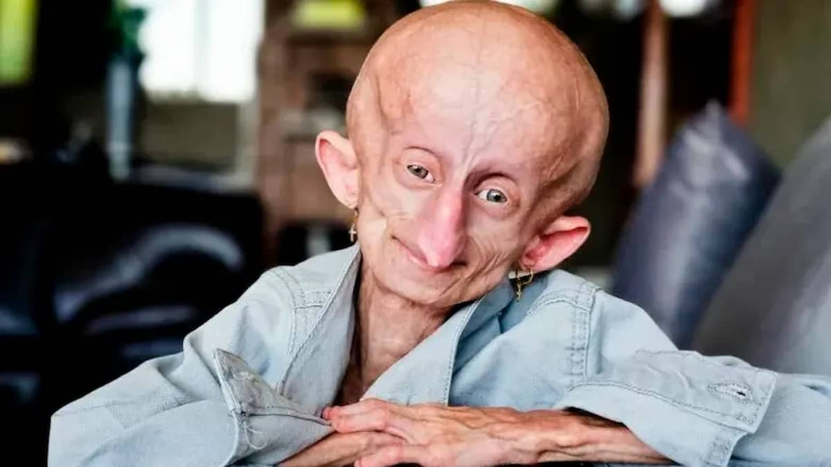 Beandri Booysen morta prima di Natale: era già vissuta 19 anni, ben oltre i 14 anni di vita dei malati di progeria