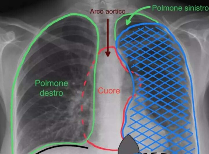 intervento polmone torino