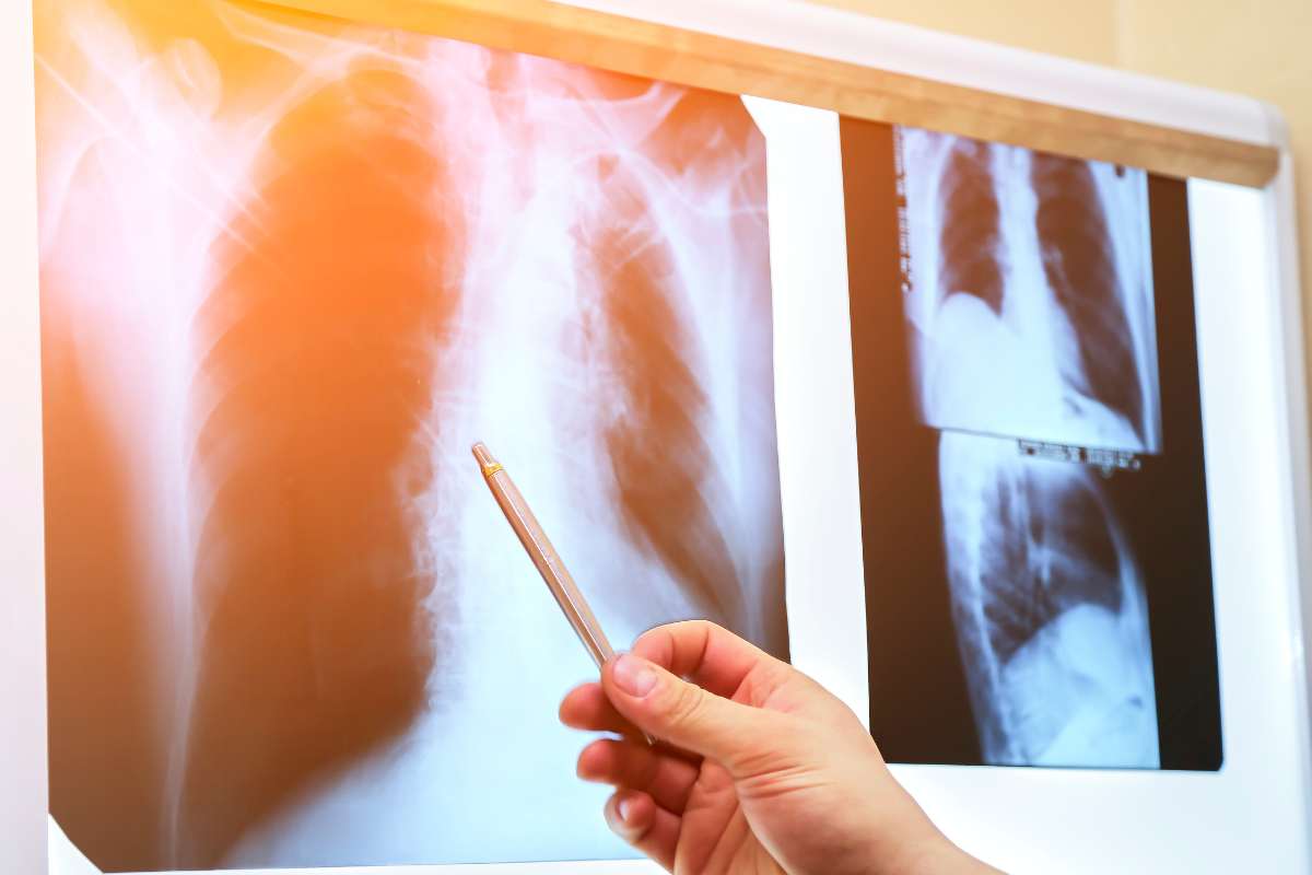 Unveiling the Real Cause of Lung Cancer: Beyond Cigarette Smoke