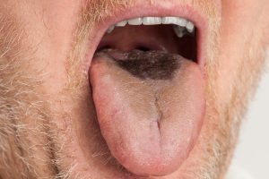 Lingua nera e pelosa dopo un incidente: l'effetto collaterale degli antibiotici