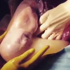 Bambino nel sacco amniotico subito dopo cesareo5